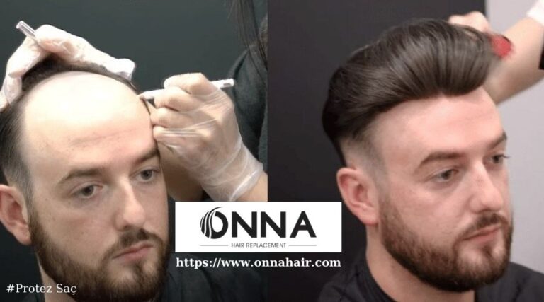 Protez Saçta Saç Rengi Seçimi: Cilt Tonunu Dikkate Alma